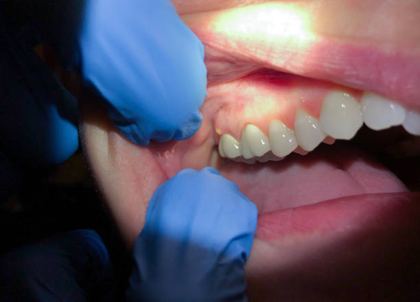 Best Tooth Infection Emergency Dentist  in Glassboro, NJ